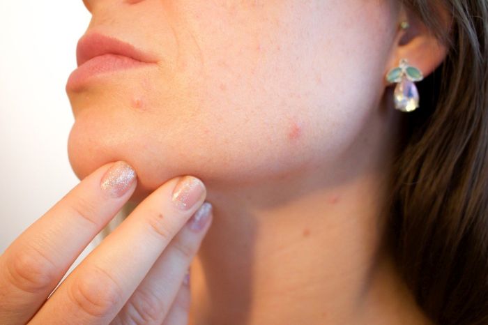 5 dicas para amenizar os efeitos causados pela acne