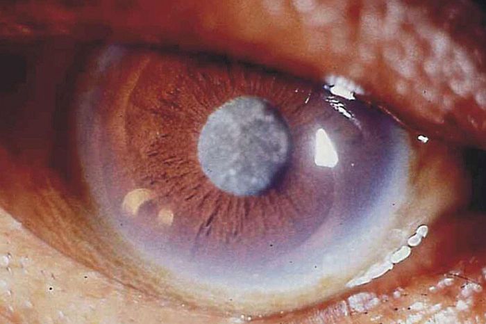 Congresso de catarata e cirurgia refrativa debate os avanços da oftalmologia no país