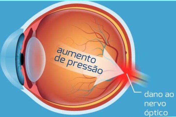 Oftalmologistas realizam campanha de combate ao glaucoma em shopping de Curitiba