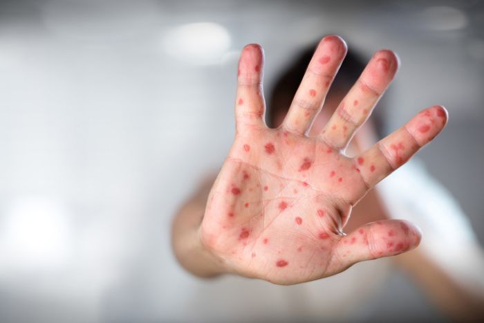 Vacina contra o sarampo: especialista esclarece as dúvidas mais frequentes do consultório