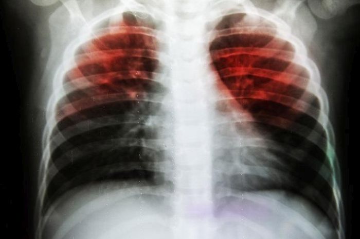 Tuberculose: um problema de saúde pública