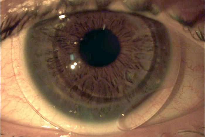 Lentes de contato e o desconforto em viagens de avião
