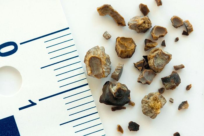 Pedra nos rins é mais comum em homens em idade produtiva